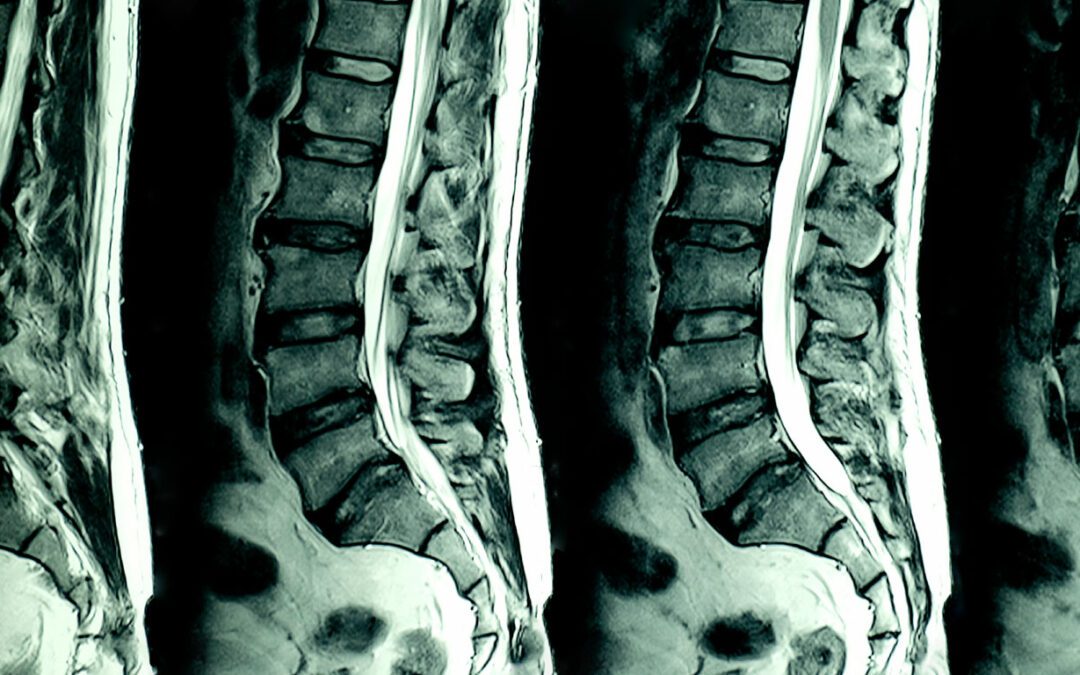 Traumatología de espalda: Lesiones más comunes