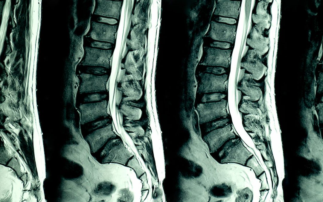 Anatomía de la espalda humana. Lesiones y patologías