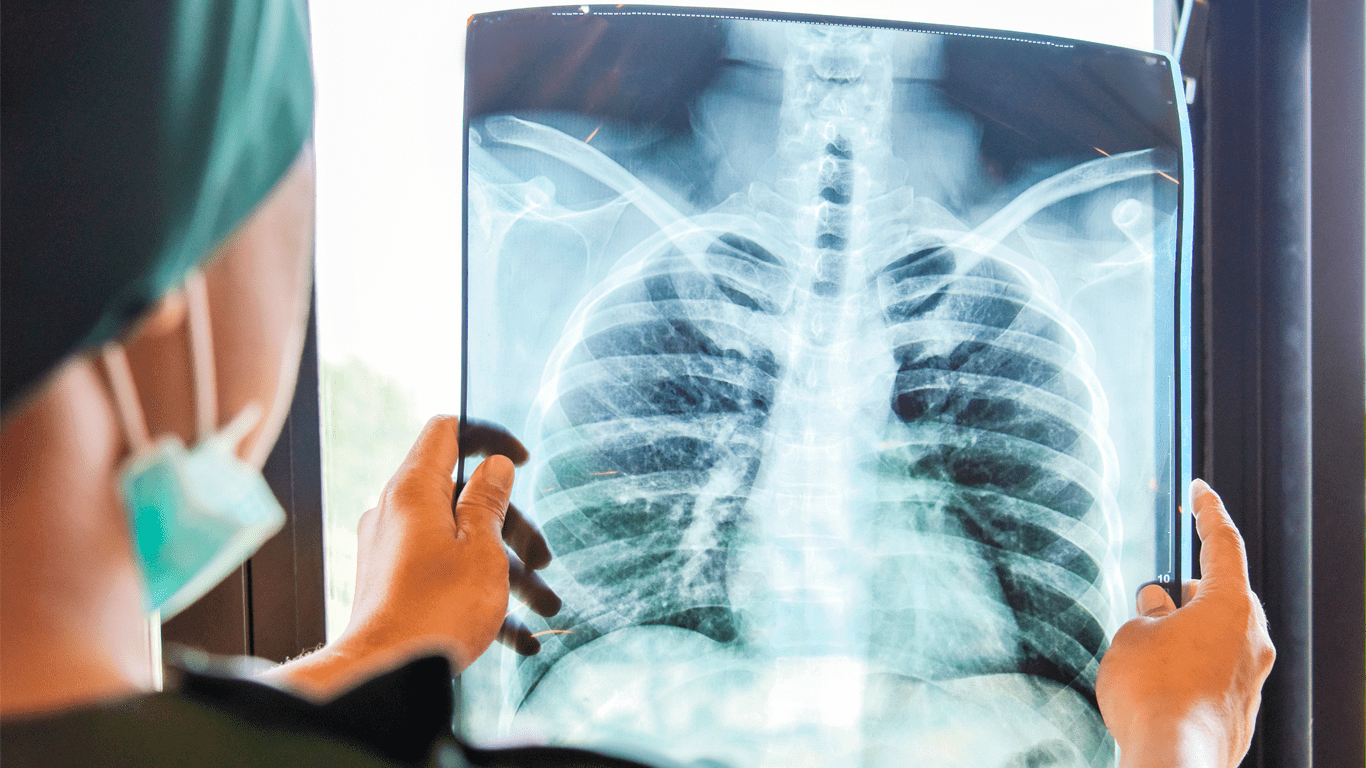 Cáncer de pulmón: El poder del diagnóstico por imágenes