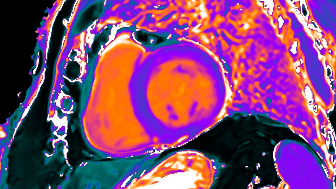 Resonancia-Magnética-Cardíaca-para-el-Diagnóstico-de-Patologías-Cardíacas