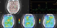 Espectroscopia por Resonancia Magnética: Un Avance en el Diagnóstico Médico