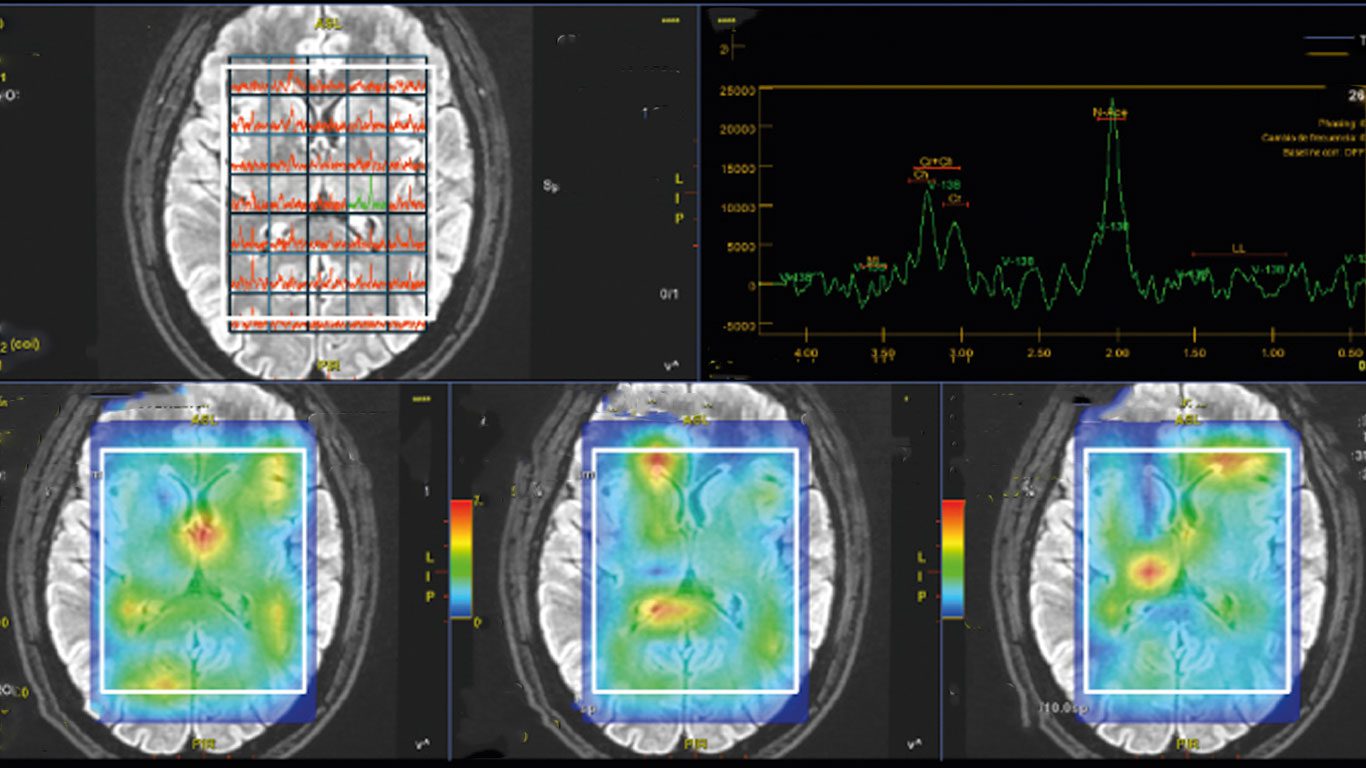 Espectroscopia por Resonancia Magnética Un Avance en el Diagnóstico Médico